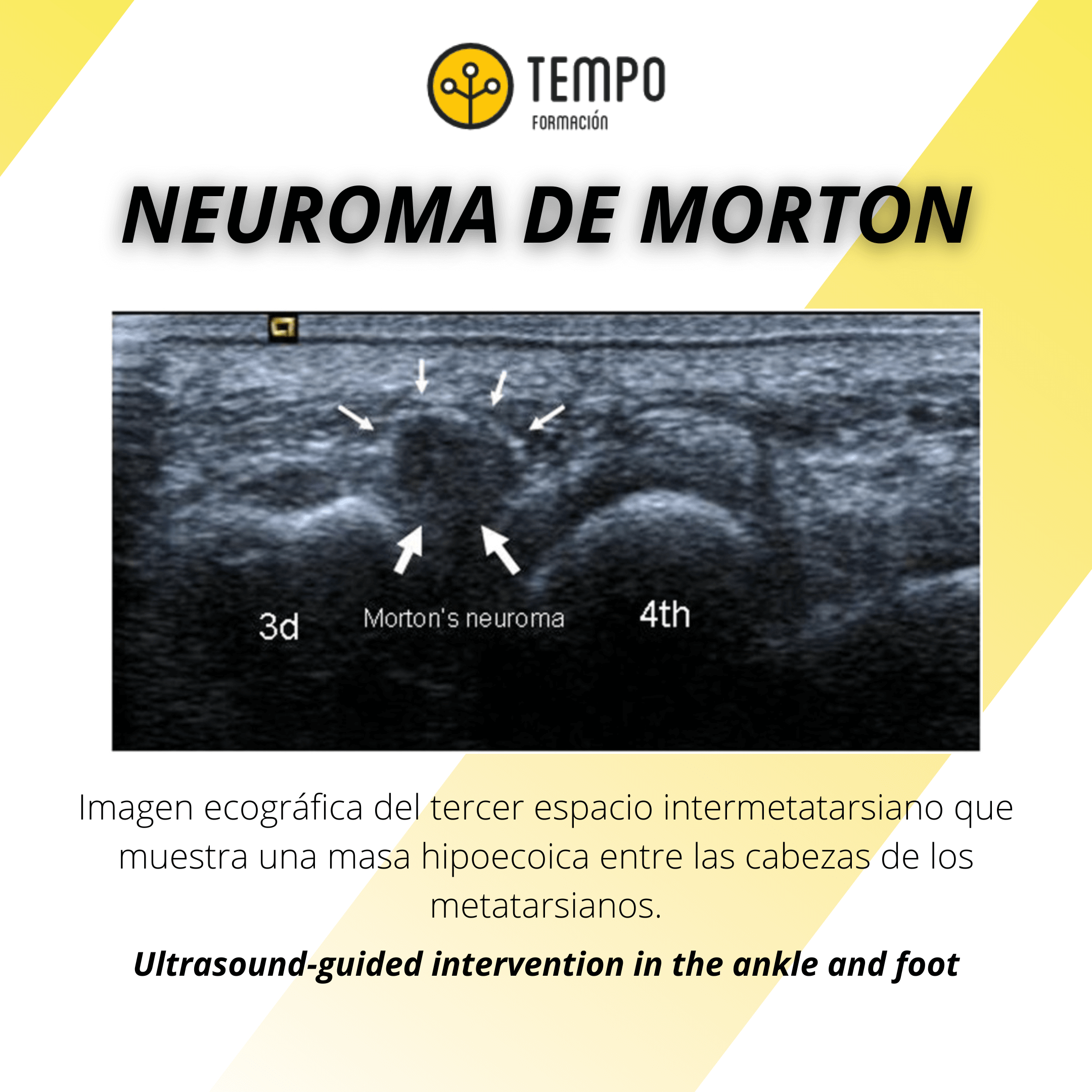 Neuroma de morton.png